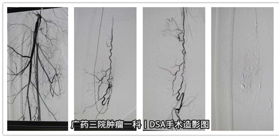 刘嘉文，男，19岁，右下肢肿物栓塞术。 (4)_副本.jpg